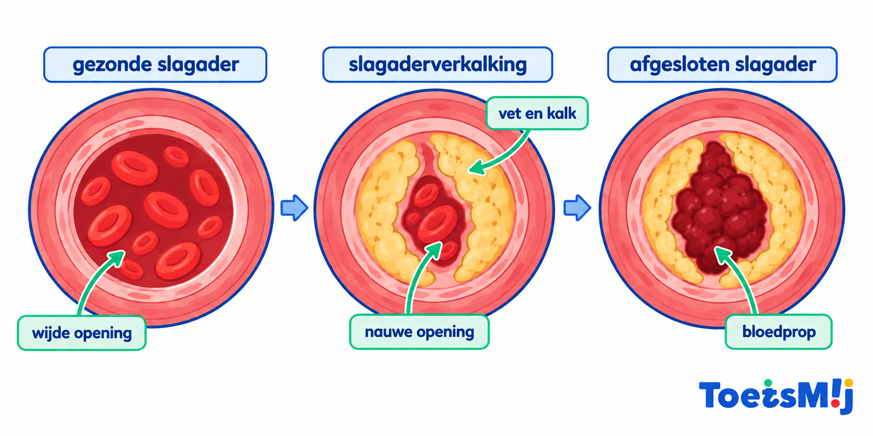 Aderverkalking
